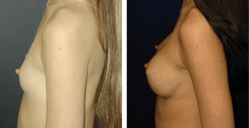 Breast augmentation real patient before and after photos