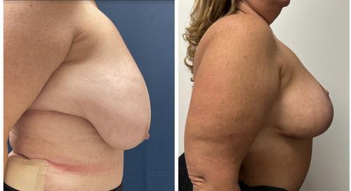 Real patient breast reconstruction 