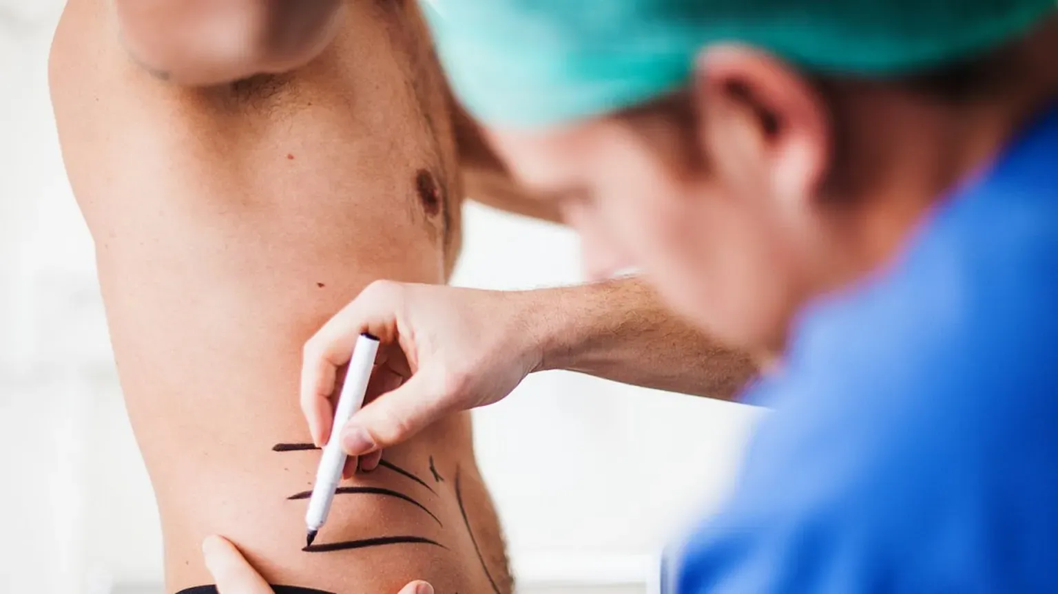 Doctor drawing on a man's midsection pre surgery