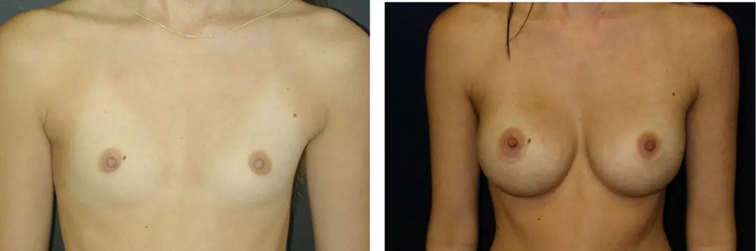 Breast Implants by Dr. Alton Ingram in Nashville TN
