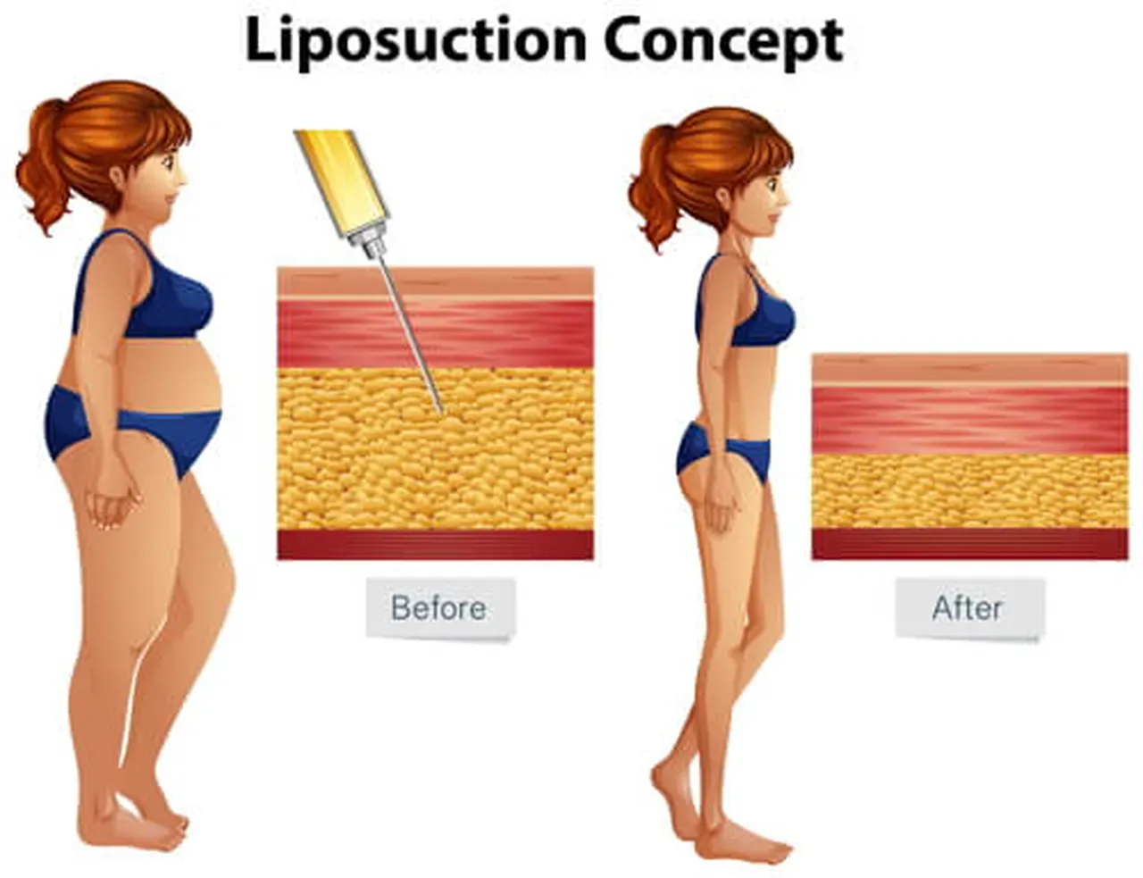 Liposuction in Nashville TN
