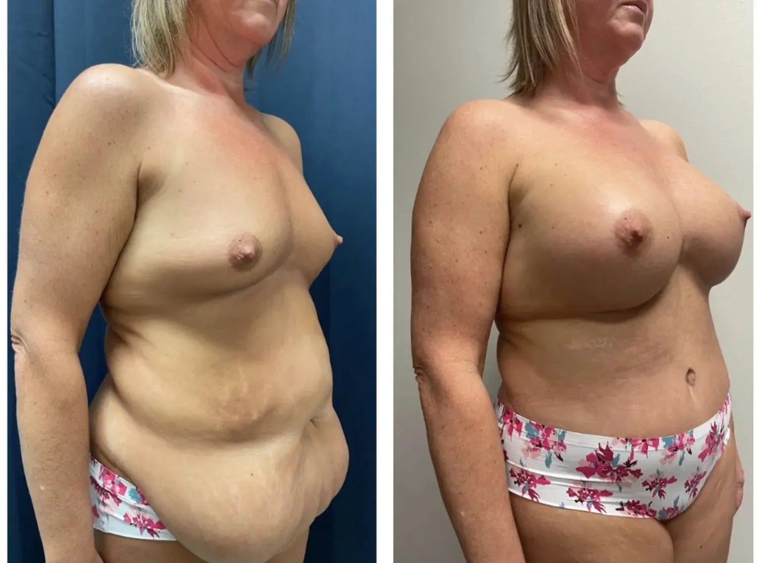 Mommy Makeover Before and After by Dr. Alton Ingram in Nashville TN