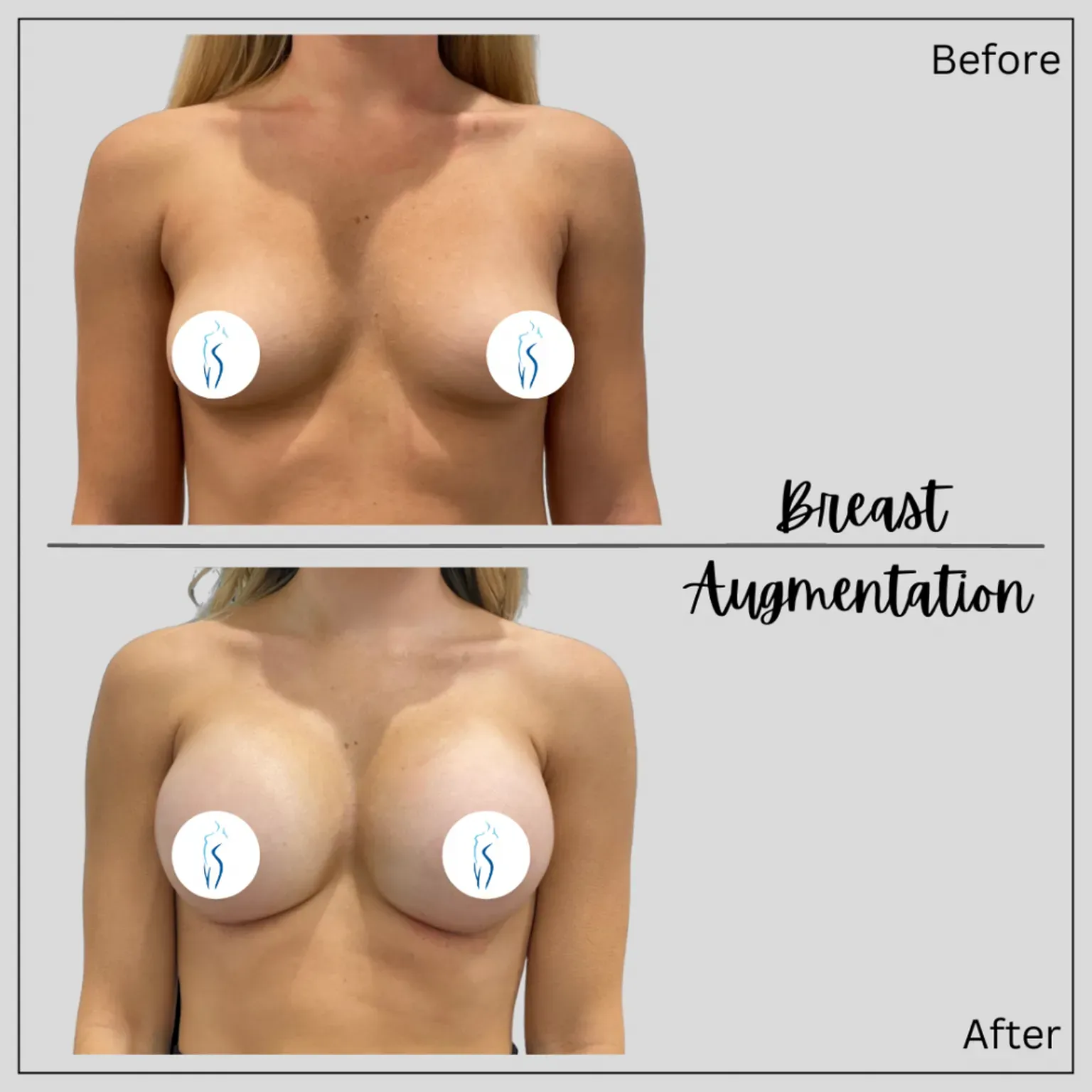 Breast Augmentation Before and After by Dr. Alton Ingram Nashville TN