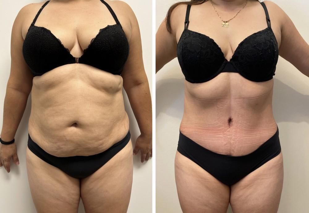Real patient before and after tummy tuck photos
