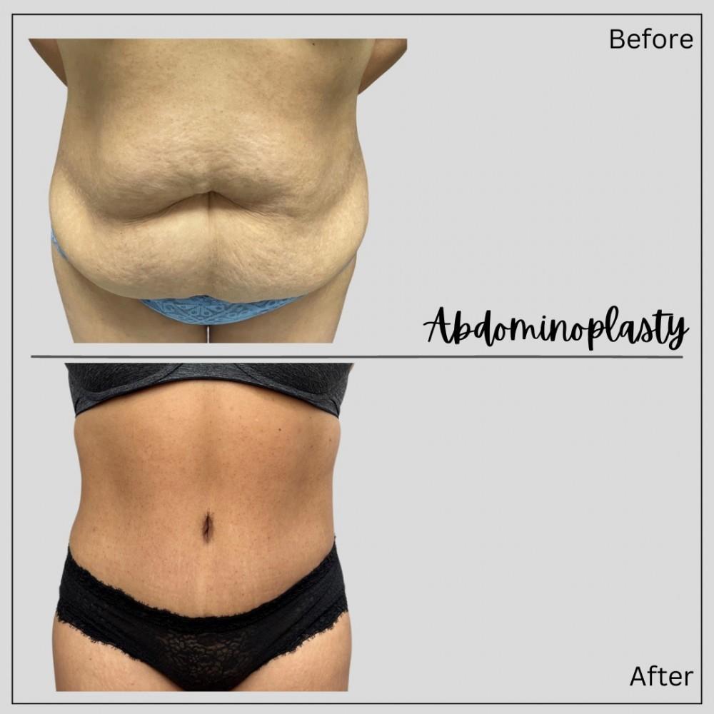 Real patient before and after photos of a tummy tuck procedure