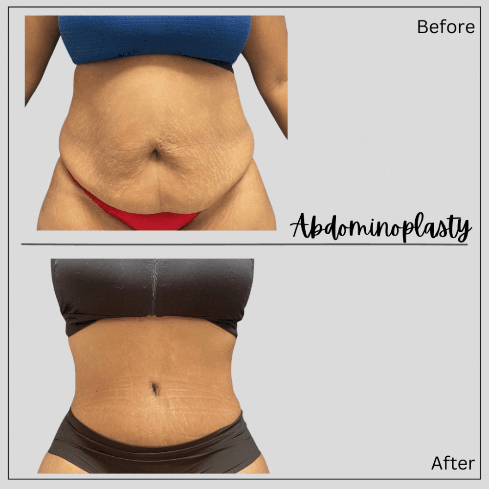 Real patient tummy tuck before and after photos