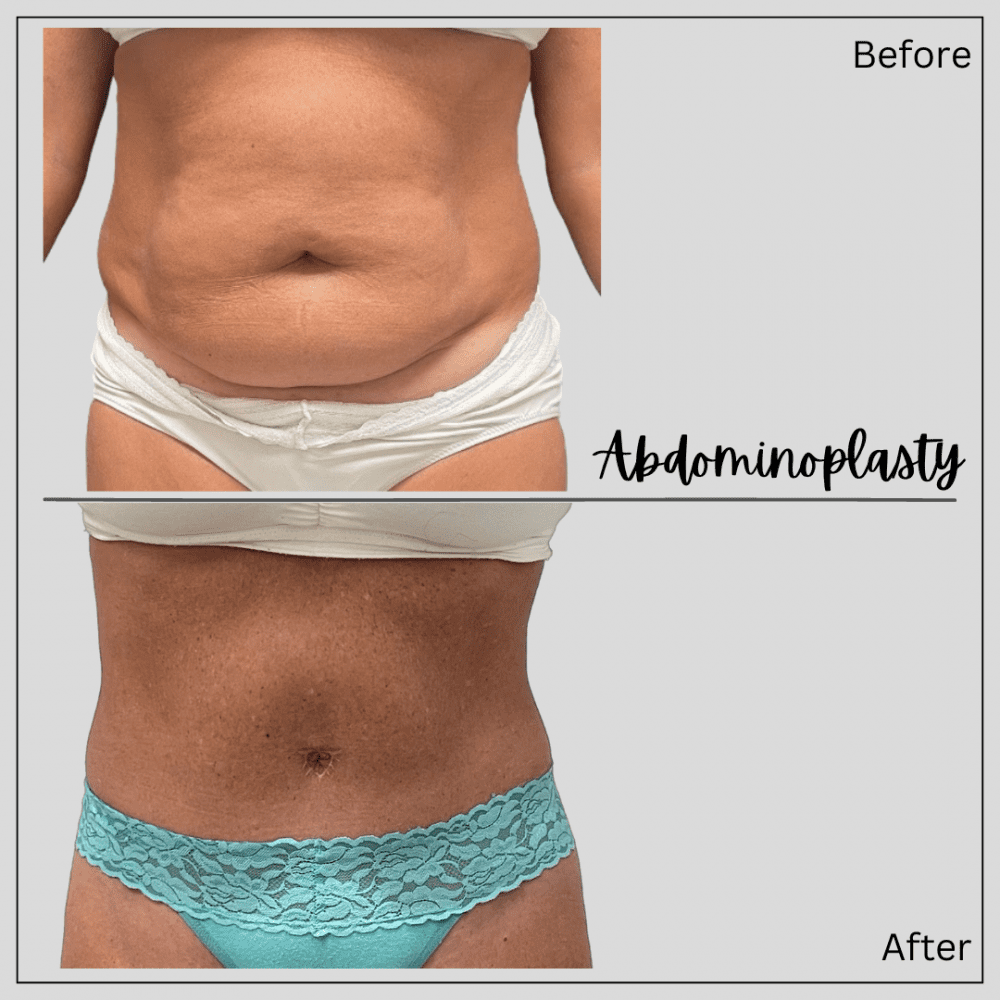 Real patient before and after photos Tummy Tuck