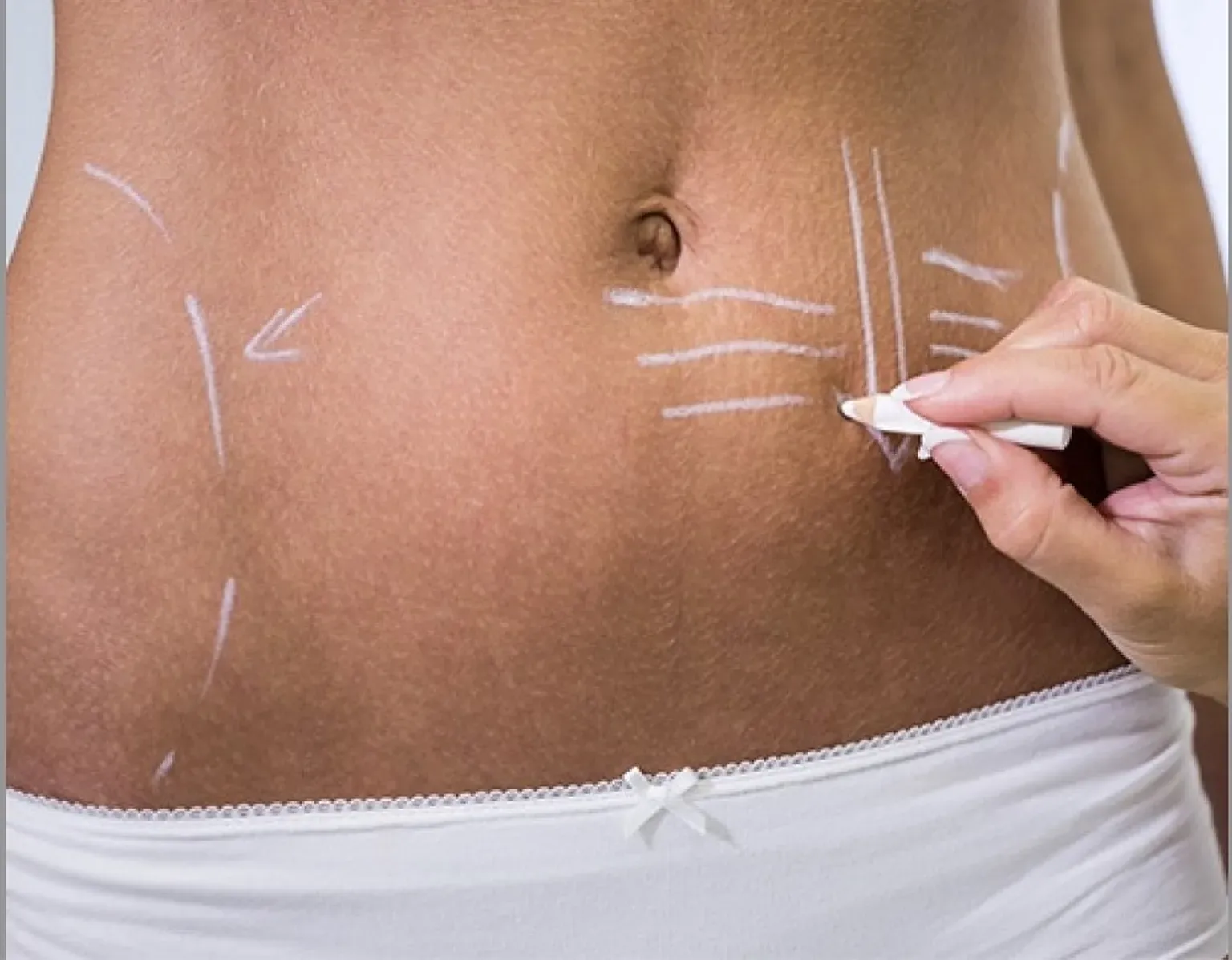 What happens to your belly button during a tummy tuck procedure
