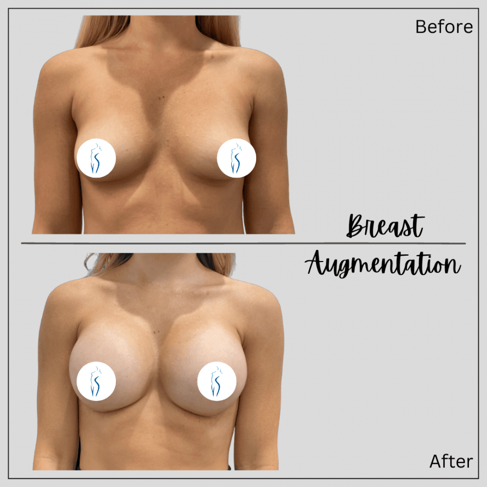 Real patient Breast Augmentation before and after photos