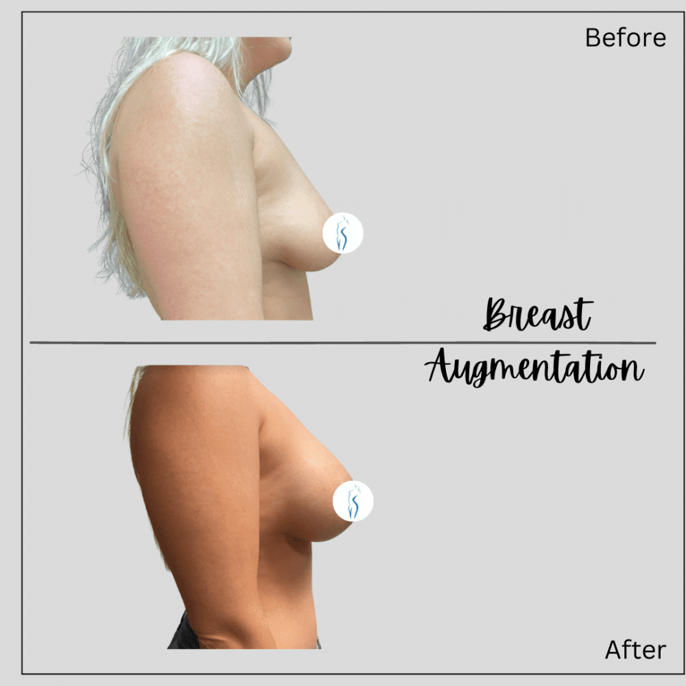 Real patient side view photo of before and after breast augmentation