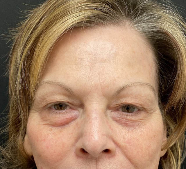Blepharoplasty case #1763