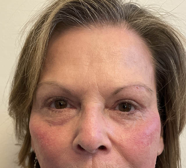 Blepharoplasty case #1763