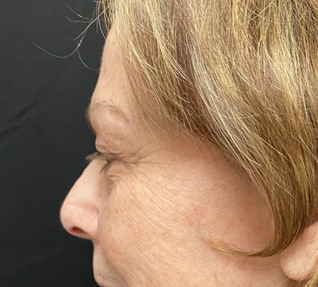 Blepharoplasty case #1763