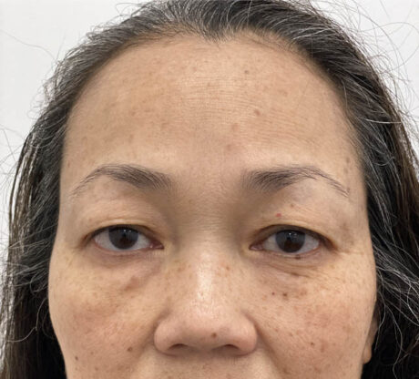 Blepharoplasty case #742