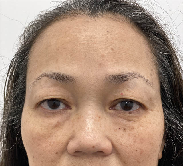 Blepharoplasty case #742