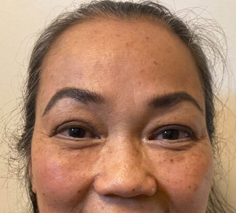 Blepharoplasty case #742