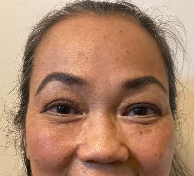 Blepharoplasty case #742