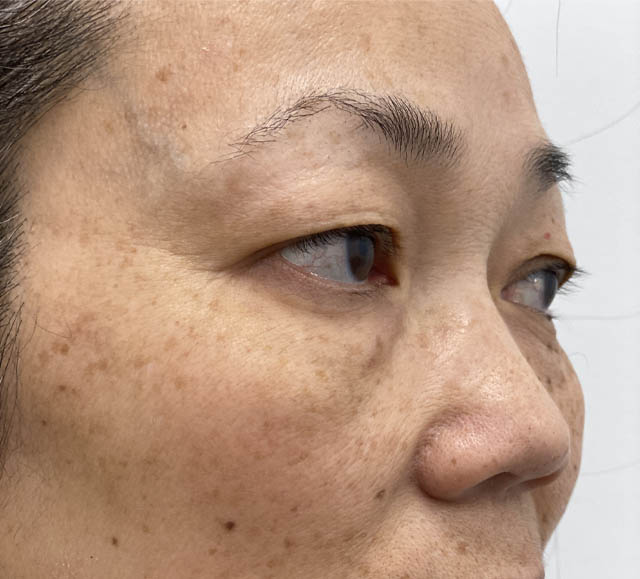 Blepharoplasty case #742
