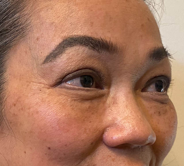 Blepharoplasty case #742