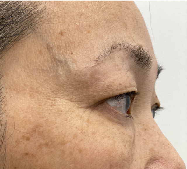 Blepharoplasty case #742