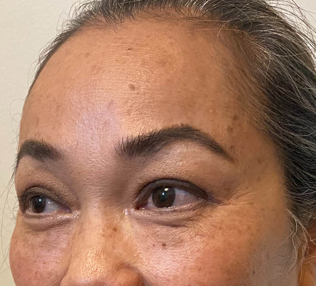 Blepharoplasty case #742