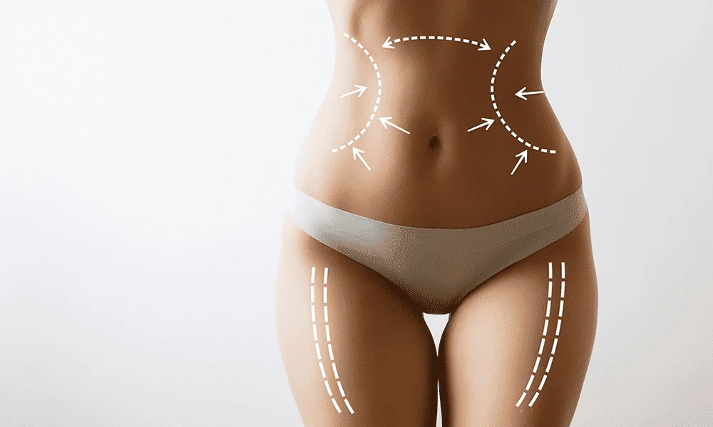 Diagram showing areas on the body for liposuction procedure