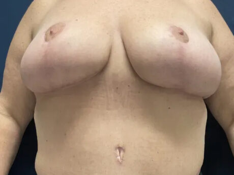 Breast Lift case #616