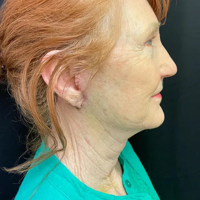plastic surgery before and after results | Ingram Cosmetic Surgery Nashville neck lift