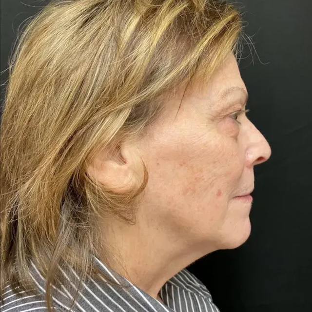 plastic surgery before and after results | Ingram Cosmetic Surgery Nashville neck lift