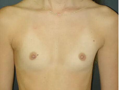 Breast Augmentation case #621