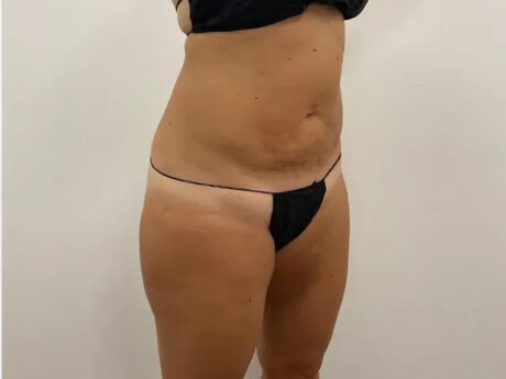 Liposuction case #562