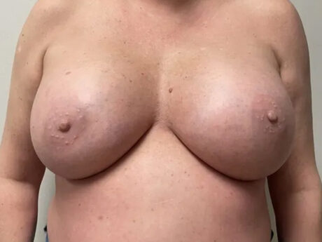 Breast Augmentation case #689