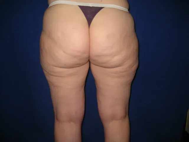 Liposuction case #548