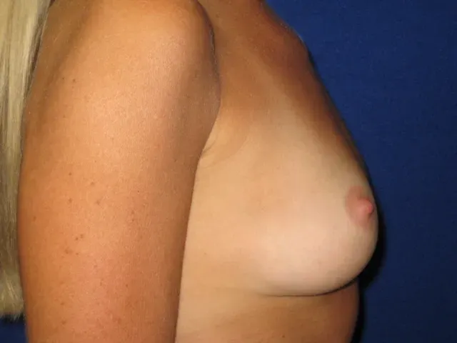 Breast Augmentation case #626