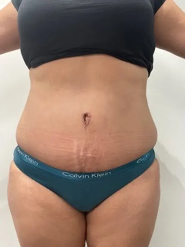 plastic surgery before and after results | Ingram Cosmetic Surgery Nashville tummy tuck