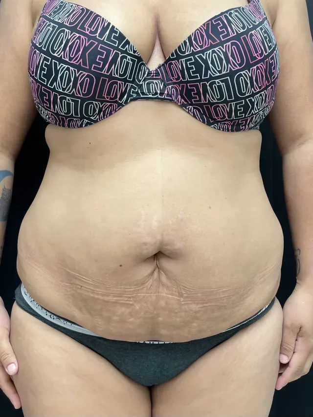 plastic surgery before and after results | Ingram Cosmetic Surgery Nashville tummy tuck