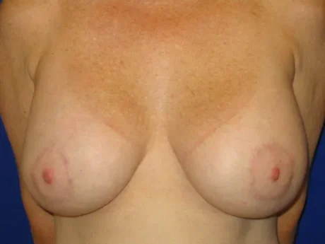 Breast Lift case #603