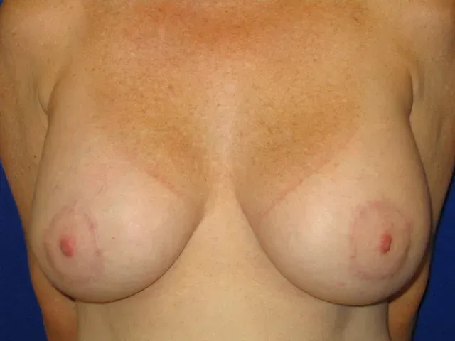 plastic surgery before and after results | Ingram Cosmetic Surgery Nashville breast procedure