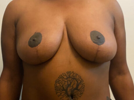 Breast Lift case #2662