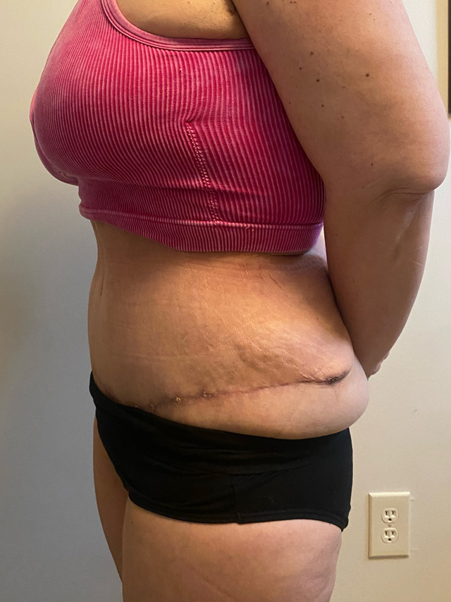 Skin Removal After Bariatric Weightloss case #2729