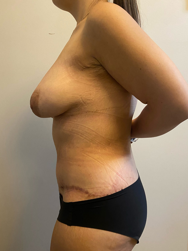 Skin Removal After Bariatric Weightloss case #2717