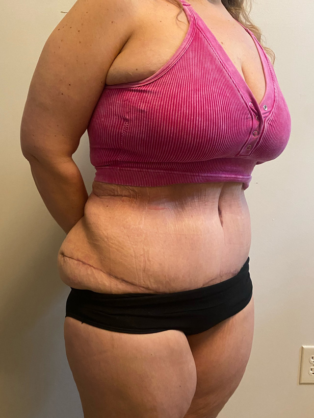 Skin Removal After Bariatric Weightloss case #2729