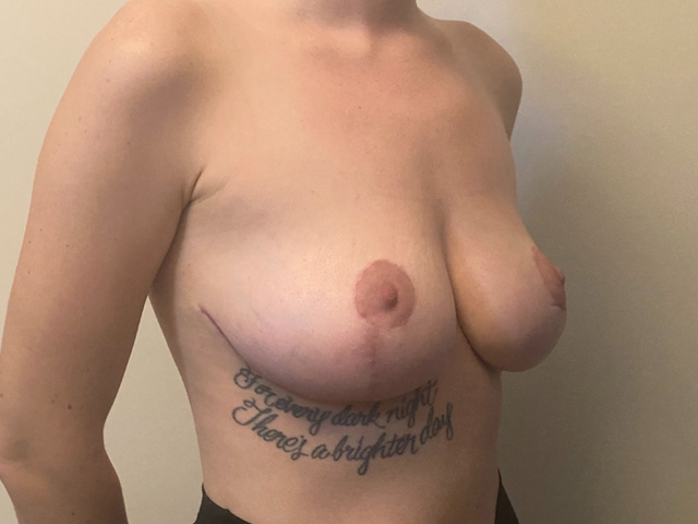 Breast Lift case #2629