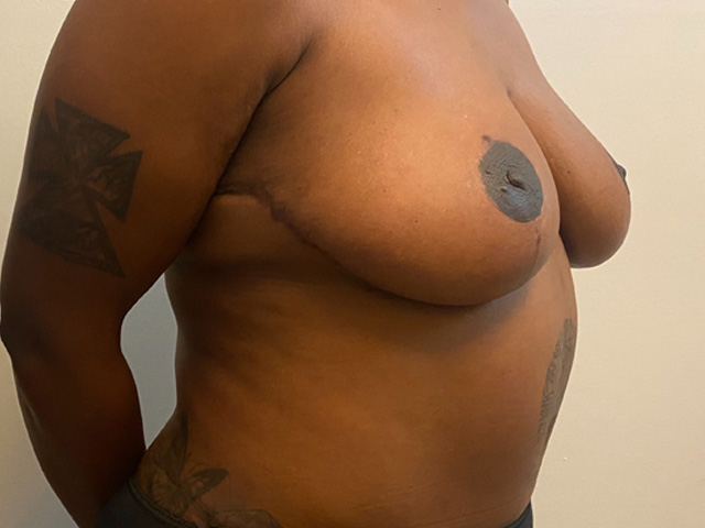 Breast Lift case #2662