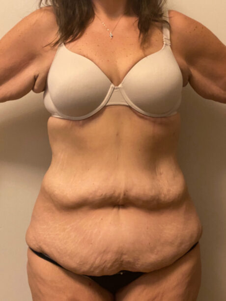 Skin Removal After Bariatric Weightloss case #2718