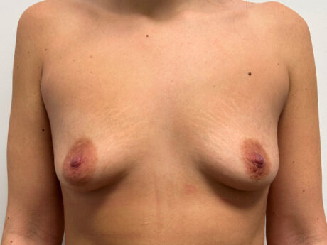 Breast Augmentation case #2596