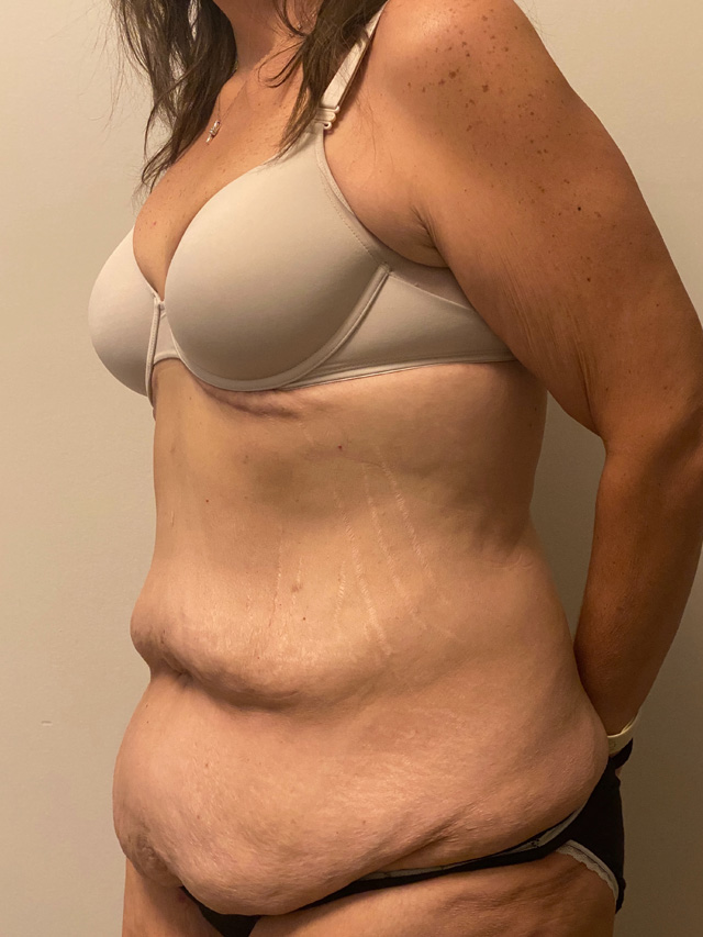 Skin Removal After Bariatric Weightloss case #2718