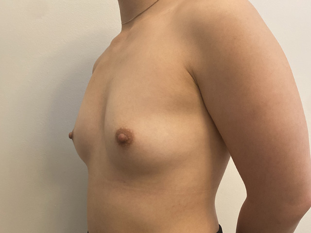 Breast Augmentation case #2574