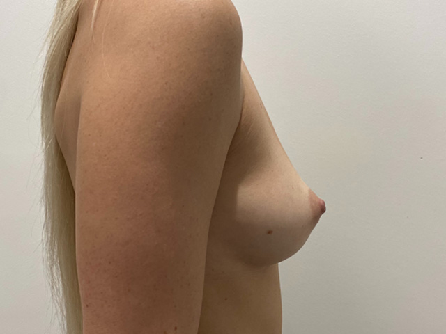 Breast Augmentation case #2607