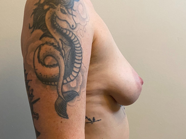 Breast Augmentation case #2618